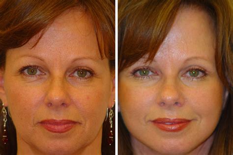 Under anaesthesia, the excess skin is trimmed off, the bulging fat bags <strong>removed</strong> / smoothened and the eyelids tightened to give you a more youthful look. . Blepharoplasty gone wrong photos